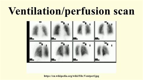 Ventilation/perfusion scan .